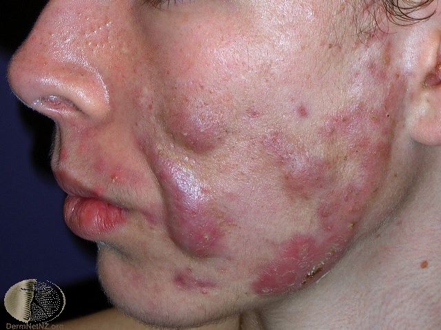 types-of-acne-with-pictures-ehealthstar