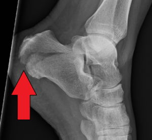 Heel Pain (Bottom, Back, Side) from Walking, Running: Causes, Treatment ...