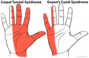 Arm Pain: Left, Right, Both, Sharp, Dull, Muscle, Nerve, in Women