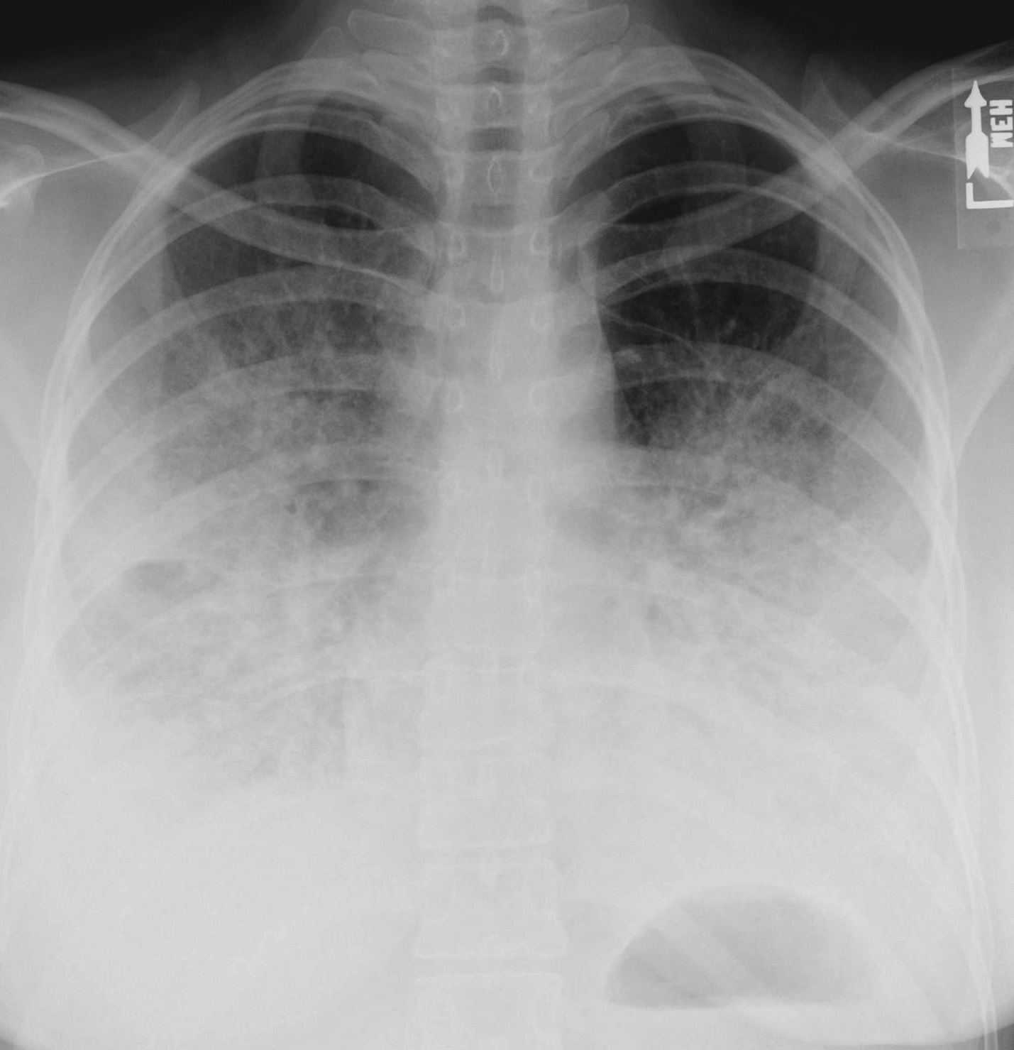 How Serious Is Bilateral double Pneumonia EHealthStar