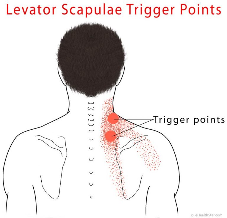 Levator Scapulae Pain Syndrome Trigger Points Stretch Ehealthstar