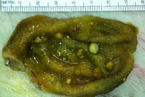 gallbladder polyps ehealthstar cholesterol