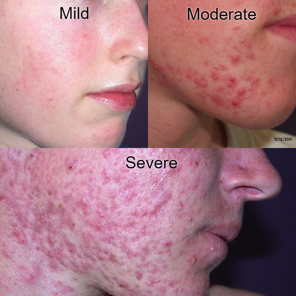 Types Of Acne With Pictures Mild Moderate Severe EHealthStar