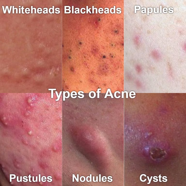 How to get rid of acne? Causes, Foods, Prevention, Treatment - eHealthStar