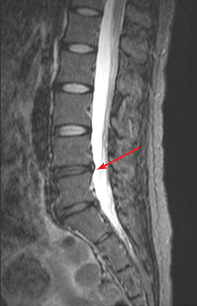 annular-tear-or-fissure-ehealthstar