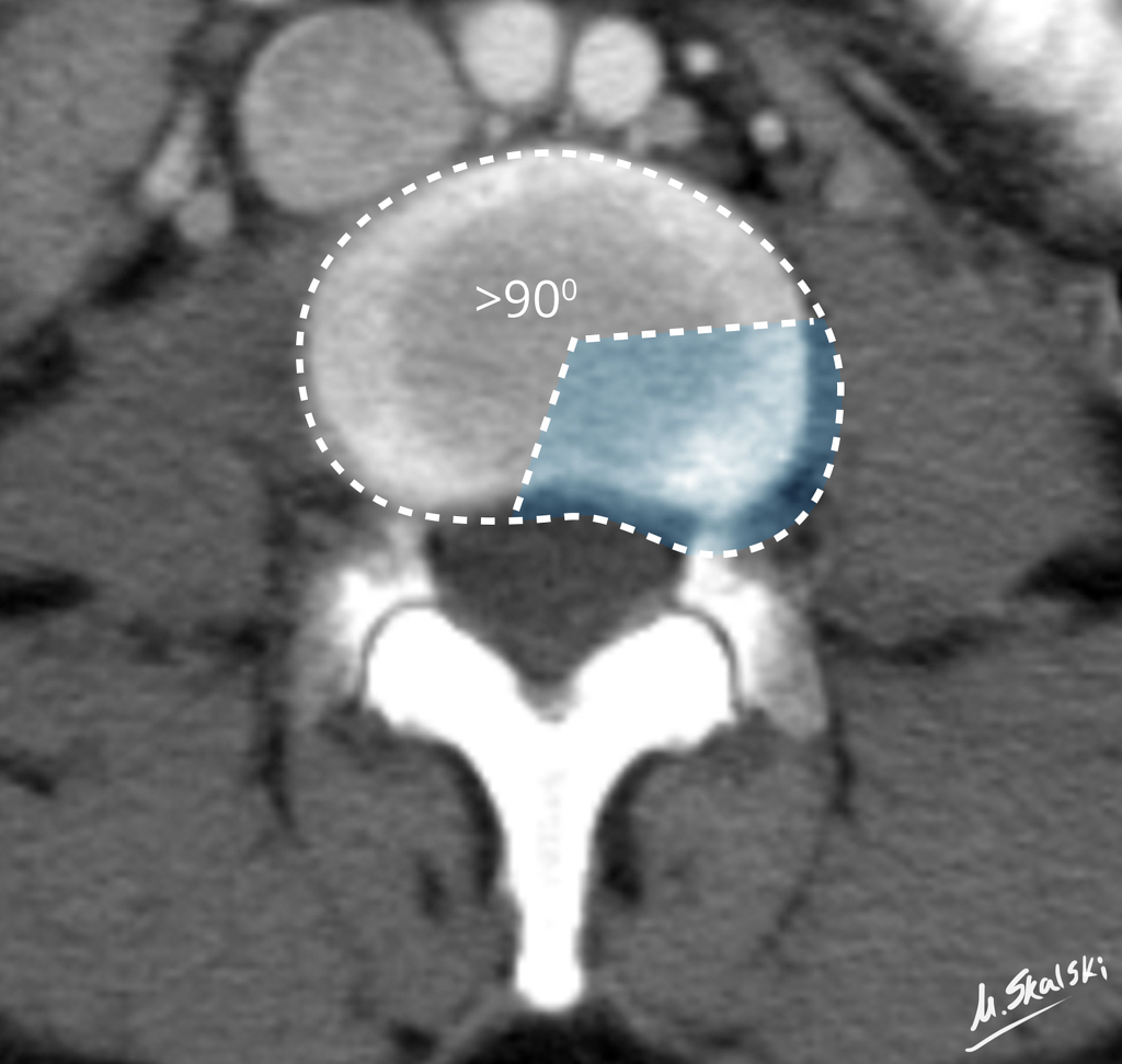 Diffuse Disc Bulge Explanation Of The Terms From MRI Reports EHealthStar