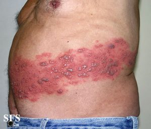 Shingles (Herpes Zoster) | eHealthStar