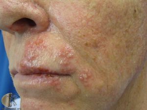 Shingles Rash: Mild, Early Stages, Pictures - Ehealthstar