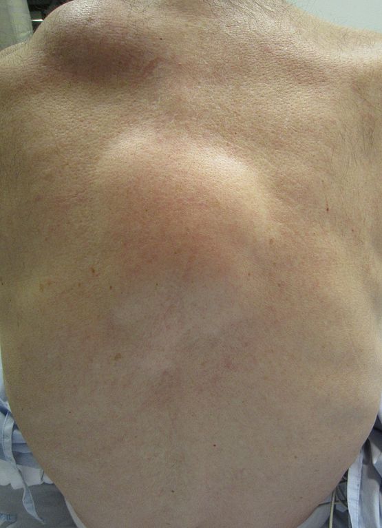 Lipoma Causes Symptoms Pictures Treatment EHealthStar