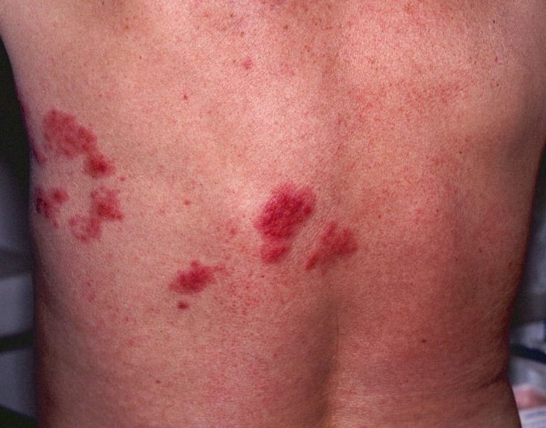 acyclovir early stage shingles treatment